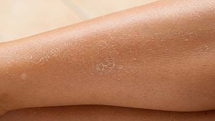 Trockene schuppige Haut an den Beinen: Was kann ich tun? - Foto: iStock / sruilk