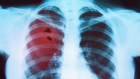 Lungenkrebs auf Röntgenbild - Foto: Istock/Fetrinka