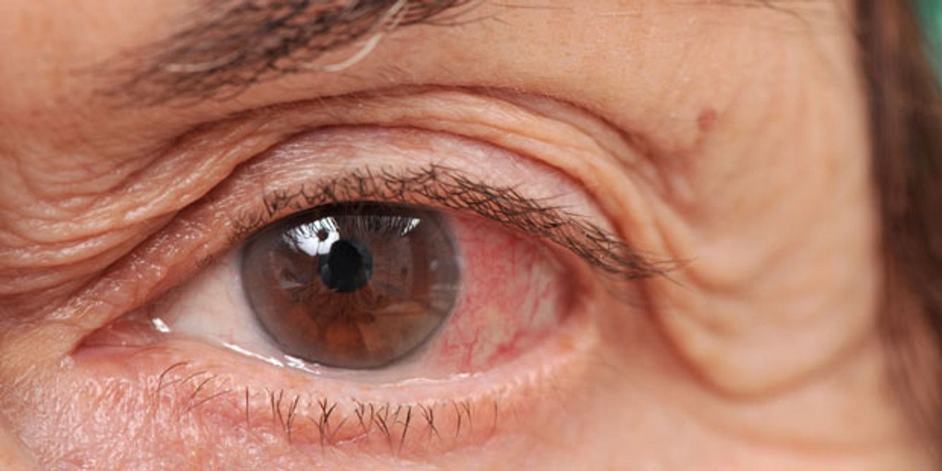 Bei einer Übersäuerung kann es zu einer Rotfärbung der Bindehaut des Auges kommen