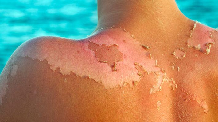 Sonnenbrand - Foto: istock
