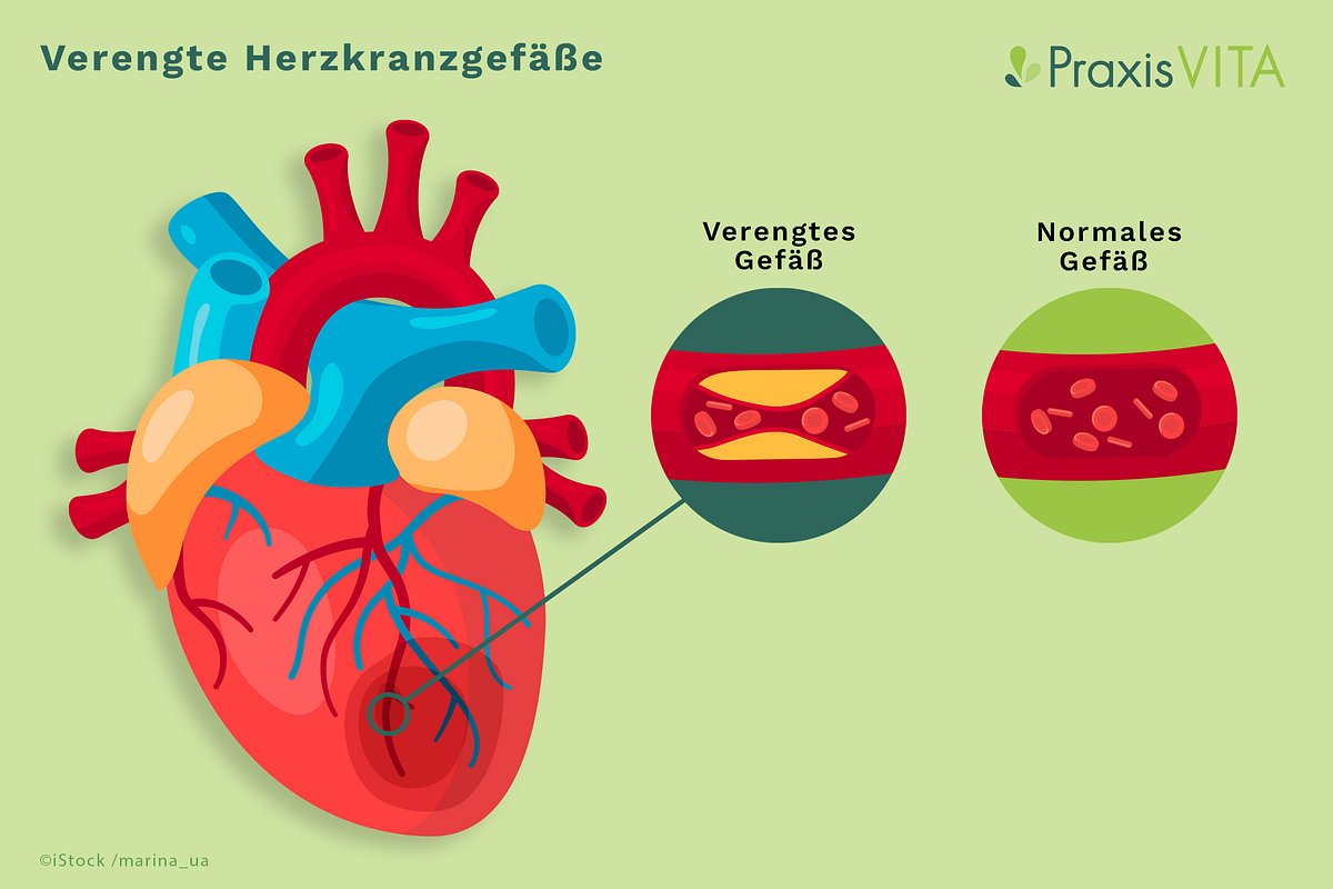 Grafik der Anatomie der Herzkranzgefäße