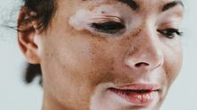 Eine Frau mit Vitiligo im Gesicht - Foto: iStock / Diamond Dogs