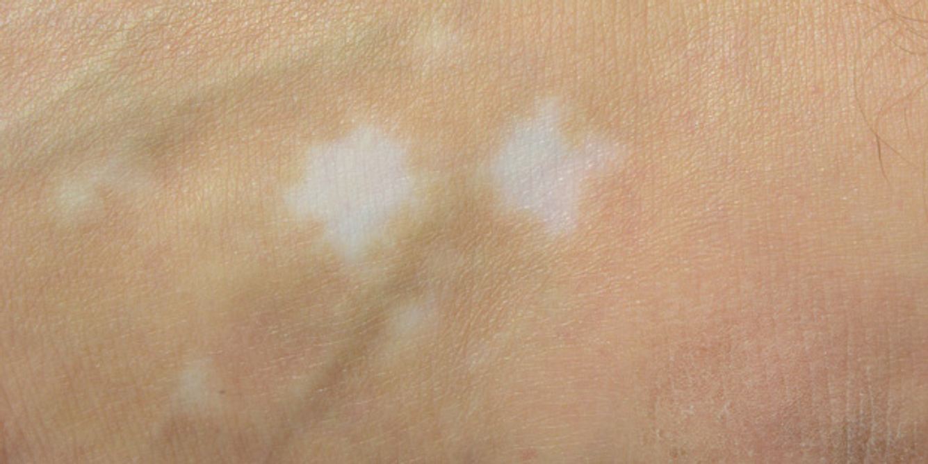 Bei der Autoimmunerkrankung Vitiligo hat die Haut stellenweise zu wenig Pigmente, statt dunkler entstehen helle Flecken