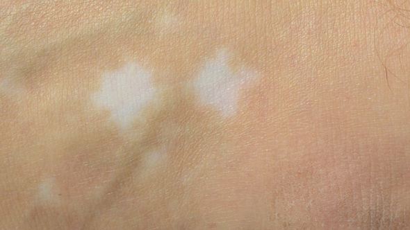 Bei der Autoimmunerkrankung Vitiligo hat die Haut stellenweise zu wenig Pigmente, statt dunkler entstehen helle Flecken - Foto: shutterstock