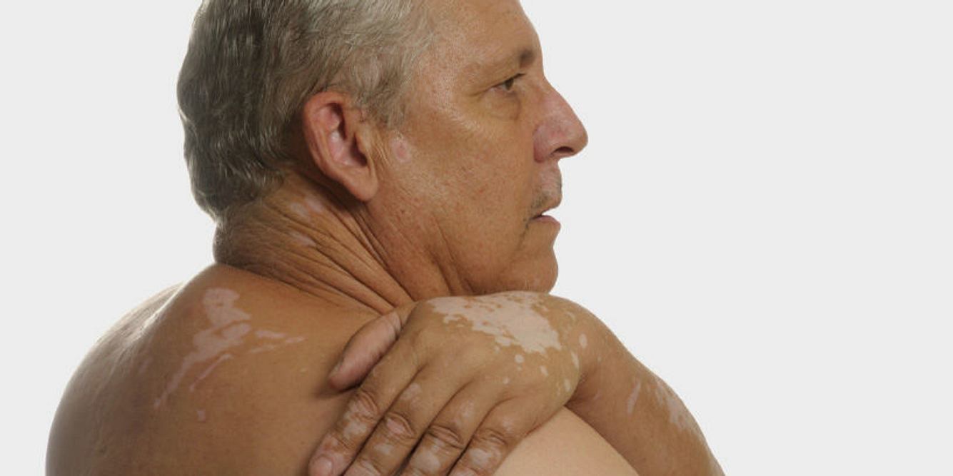Bei einzelnen weißen Flecken auf der Haut, kann es sich um Vitiligo handeln