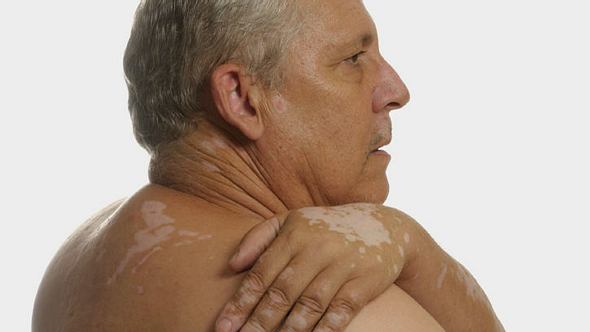 Bei einzelnen weißen Flecken auf der Haut, kann es sich um Vitiligo handeln - Foto: iStock