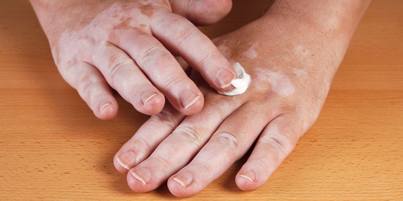 Antientzündliche Cremes können bei Vitiligo zur Repigmentierung führen