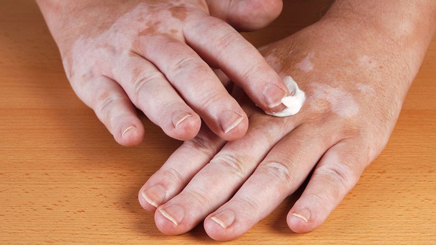 Wenn die Haut weiße Flecken bekommt - Foto: Fotolia