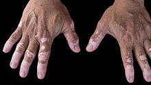 Bei Vitiligo handelt es sich um eine Pigmentstörung der Haut - Foto: Fotolia