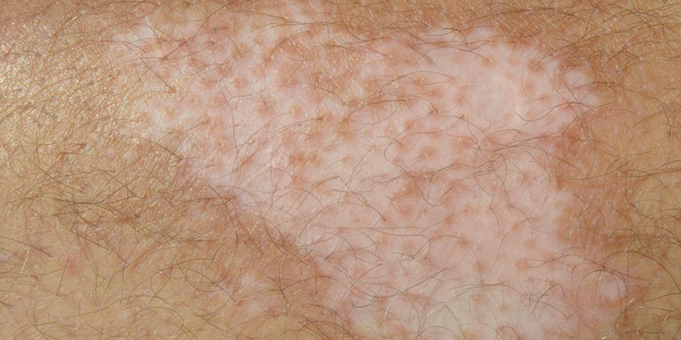 Vitiligo kann an jeder Körperstelle auftreten