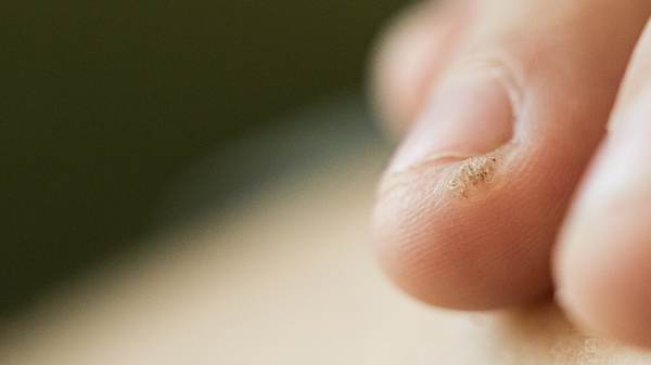 Nahaufnahme von einer Warze am Finger - Foto: iStock/Irina Zharkova