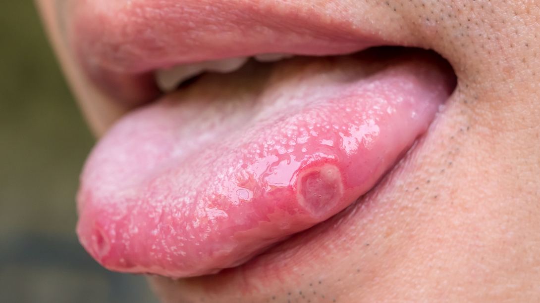 Eine Nahaufnahme einer Zunge mit Belag - Foto: iStock/trumzz