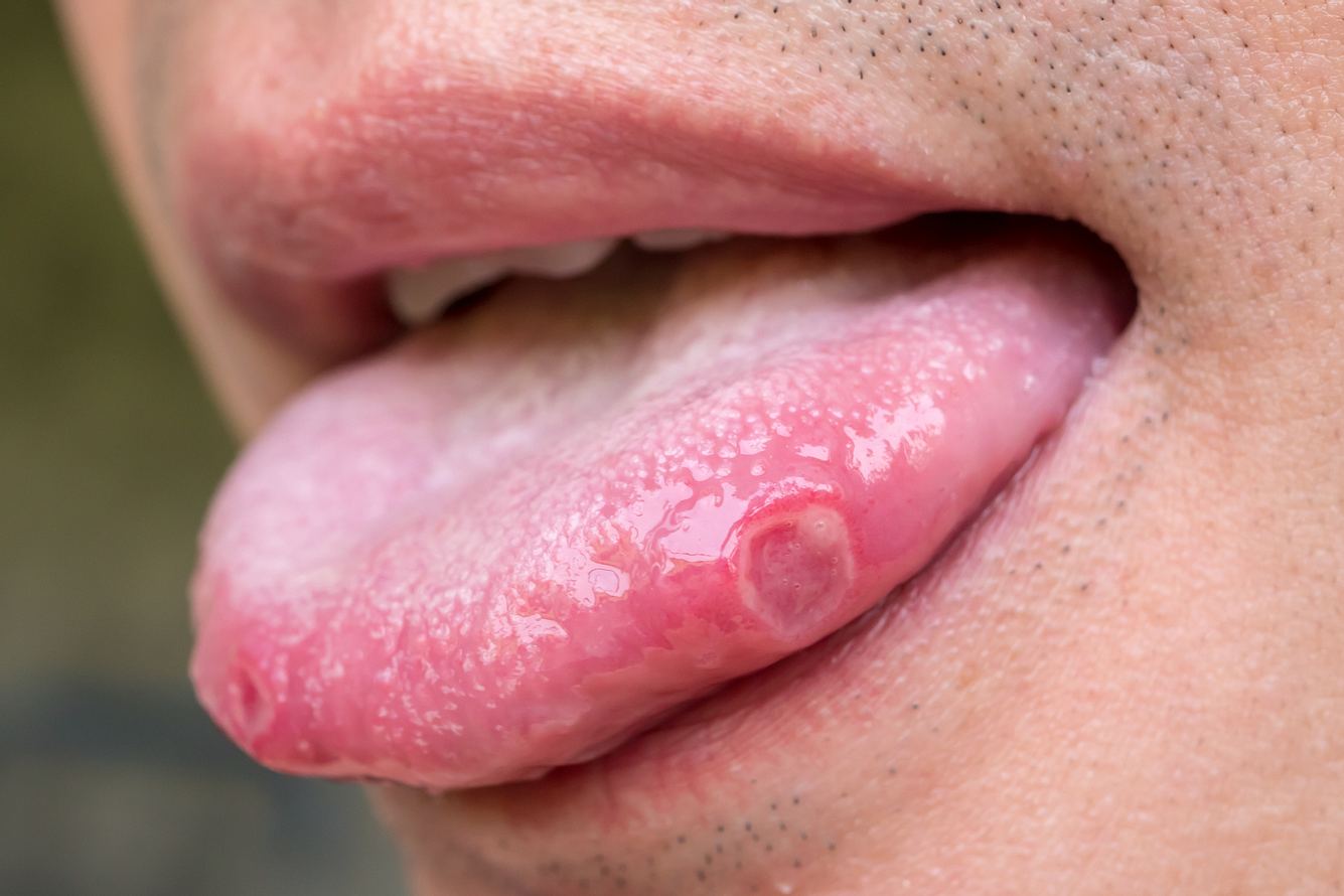 Eine Nahaufnahme einer Zunge mit Belag