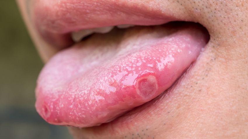 Eine Nahaufnahme einer Zunge mit Belag - Foto: iStock/trumzz