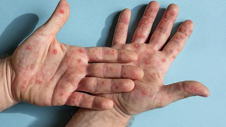 Person mit Hautausschlag an den Händen - Foto: Istock/Marina Demidiuk