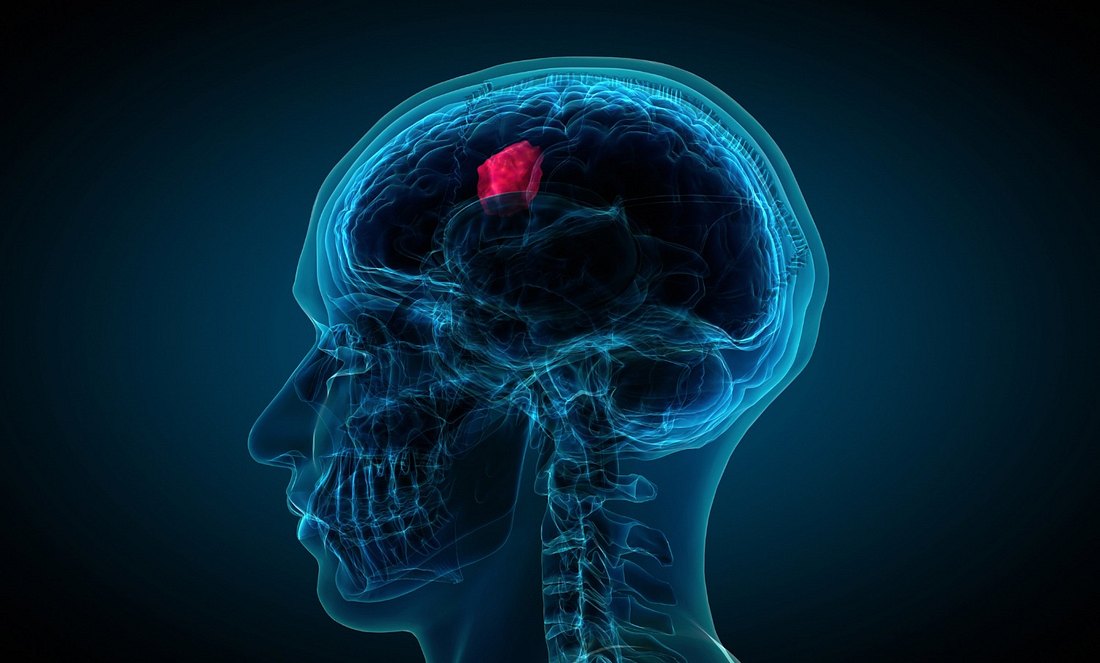 Gehirn mit Tumor