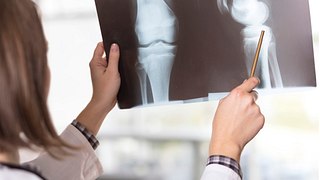Osteoporose kann zu Knochenbrüchen führen - Foto: vladans/iStock