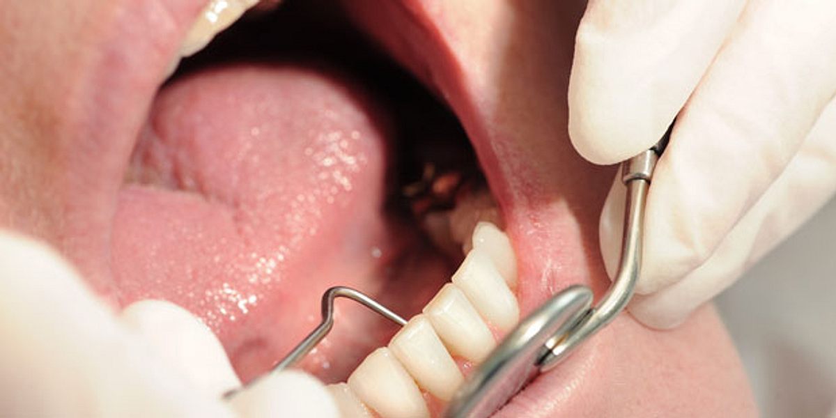 Bei einer Parodontitis ist der Zahnhalteapparat angegriffen