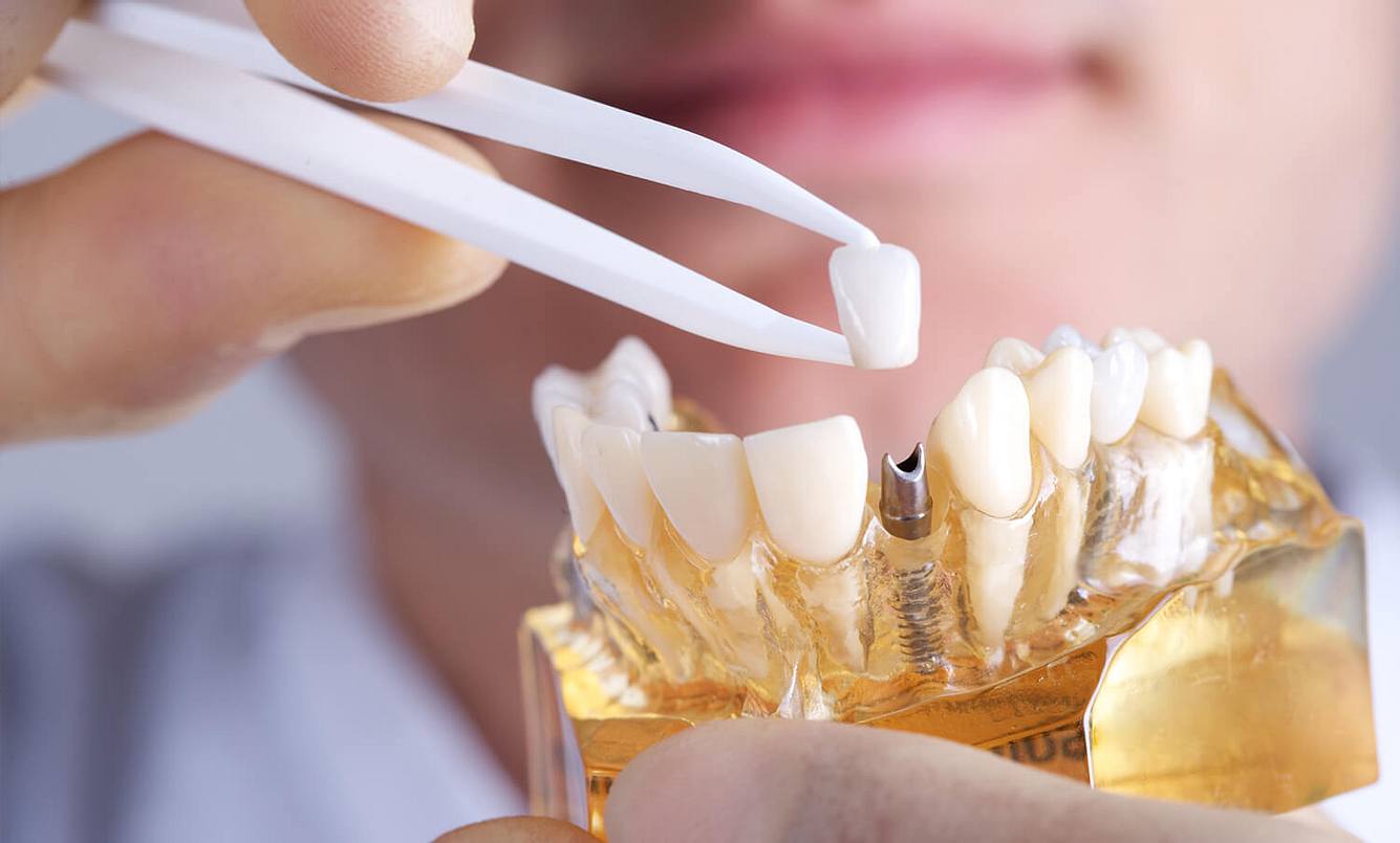 Ein Zahnarzt setzt in ein künstliches Gebiss ein Zahnimplantat