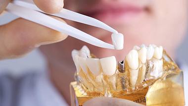 Ein Zahnarzt setzt in ein künstliches Gebiss ein Zahnimplantat - Foto: istock_marvinh
