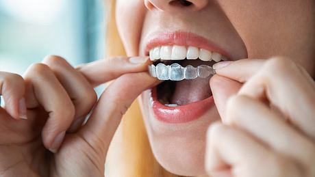 Nahaufnahme vom Mund einer Frau. Diese ist dabei sich ihre durchsichtige Zahnschiene in den Mund zu legen. - Foto: iStock/nensuria
