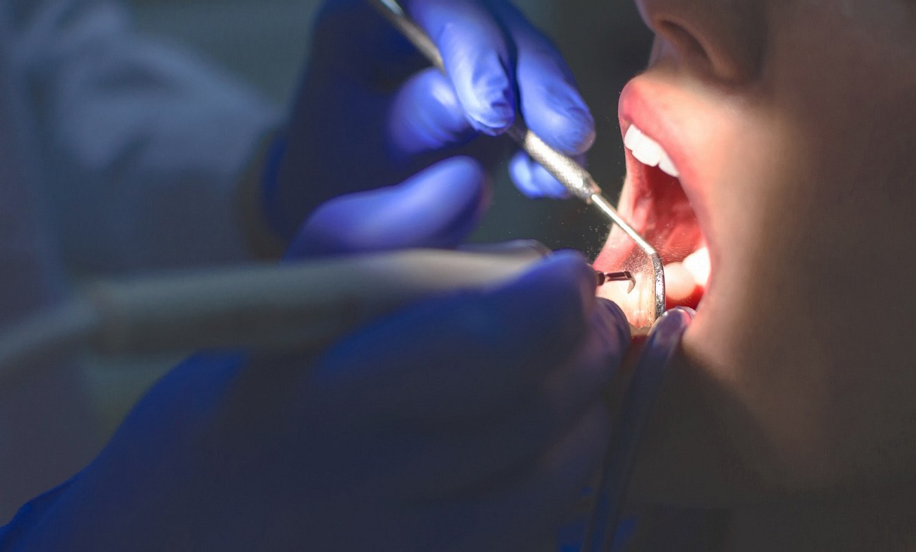 Geöffneter Mund bei einer Zahnbehandlung