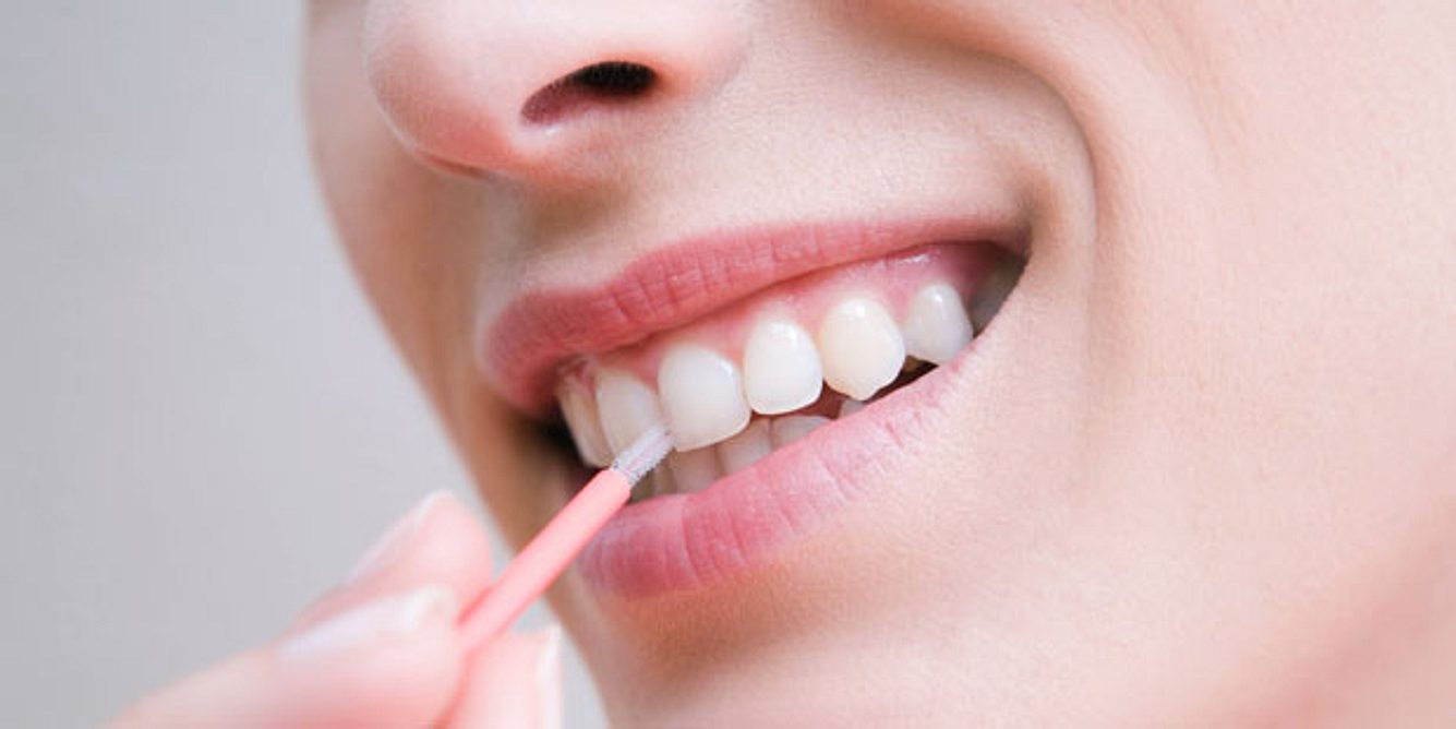 Zahnzwischenraumbürste gegen Parodontitis