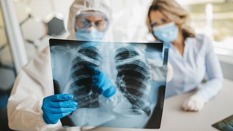 Ärztin und Arzt werten Lungen-Röntgenbild aus - Foto: iStock / bojanstory