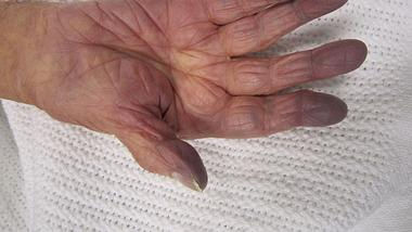 Zyanose-Hand - Foto: James Heilman, commons.wikimedia.org